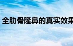 全肋骨隆鼻的真实效果（取肋骨隆鼻的风险）