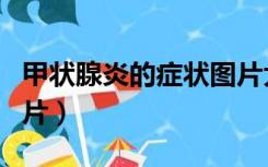 甲状腺炎的症状图片大全（甲状腺炎的症状图片）