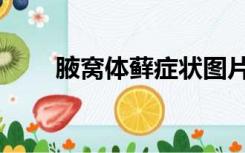 腋窝体藓症状图片（体藓症状图片）