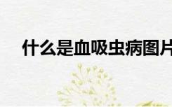 什么是血吸虫病图片（什么是血吸虫病）