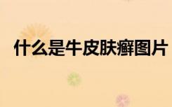 什么是牛皮肤癣图片（图片牛皮癣是什么）