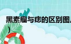 黑素瘤与痣的区别图片（黑素瘤与痣的区别图）