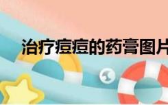 治疗痘痘的药膏图片（治疗痘痘的药膏）