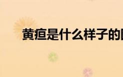 黄疸是什么样子的图片（黄疸是什么）